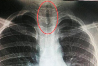 Kinh hãi cậu bé 11 tuổi 'nuôi' đỉa dài 7cm trong cổ họng 